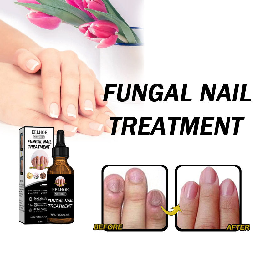 Onychomycosis Dead Nail Treatment And Nail Repairing Lotion