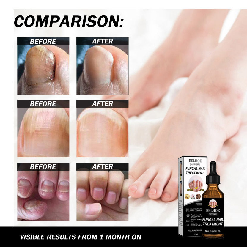 Onychomycosis Dead Nail Treatment And Nail Repairing Lotion